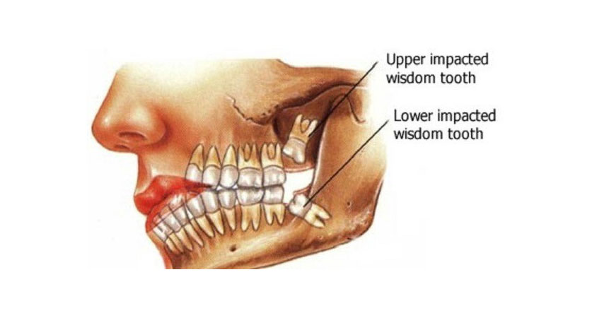 wisdom tooth hole