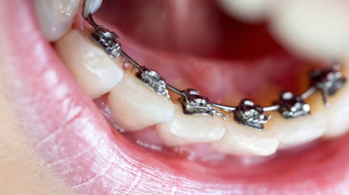 Lingual braces