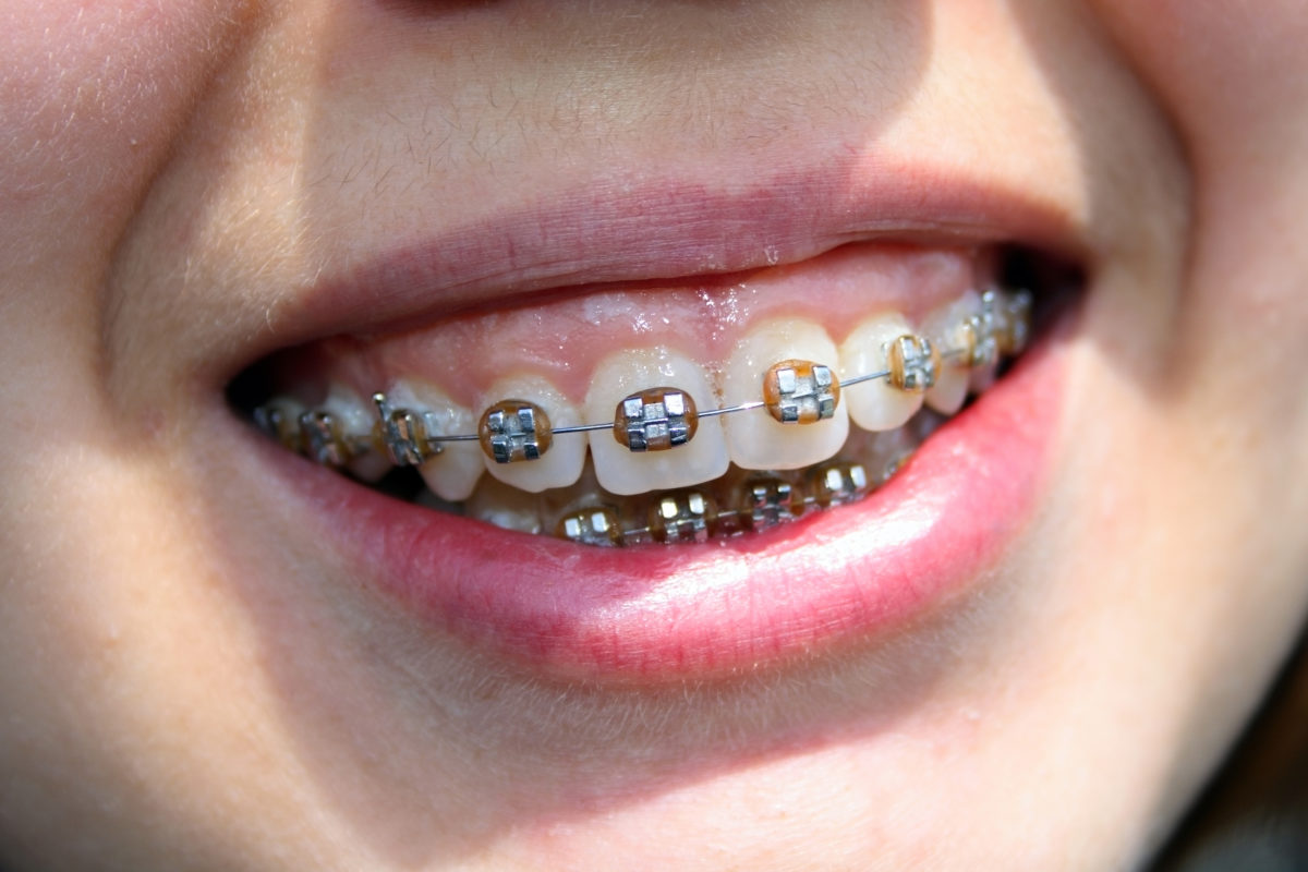 braces in Miami, Florida