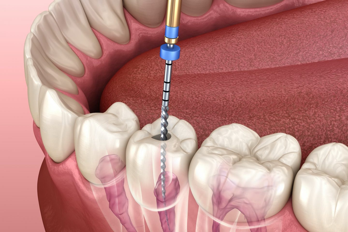 Root Canal Dentist Near Me