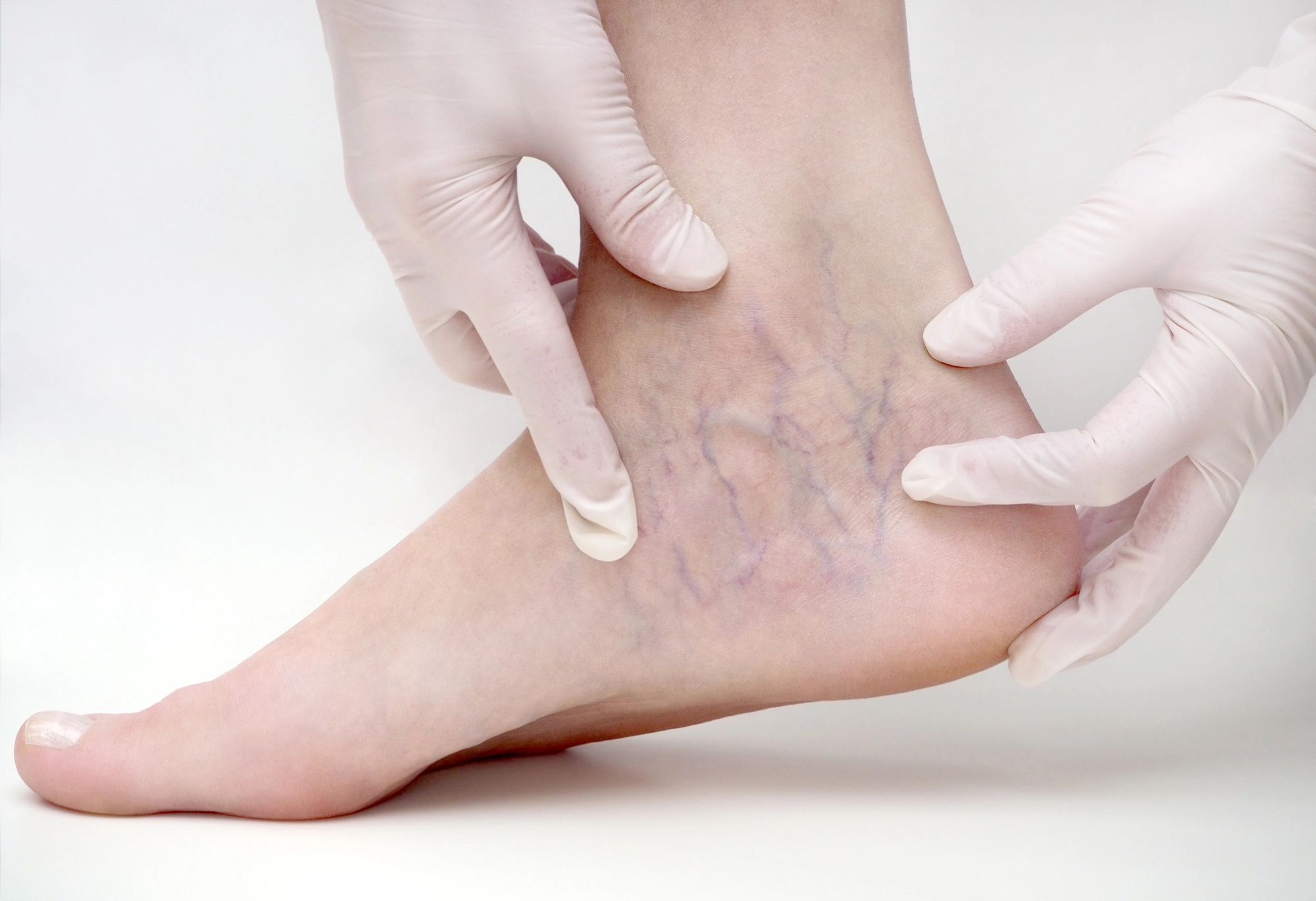  What type of doctor treats varicose veins