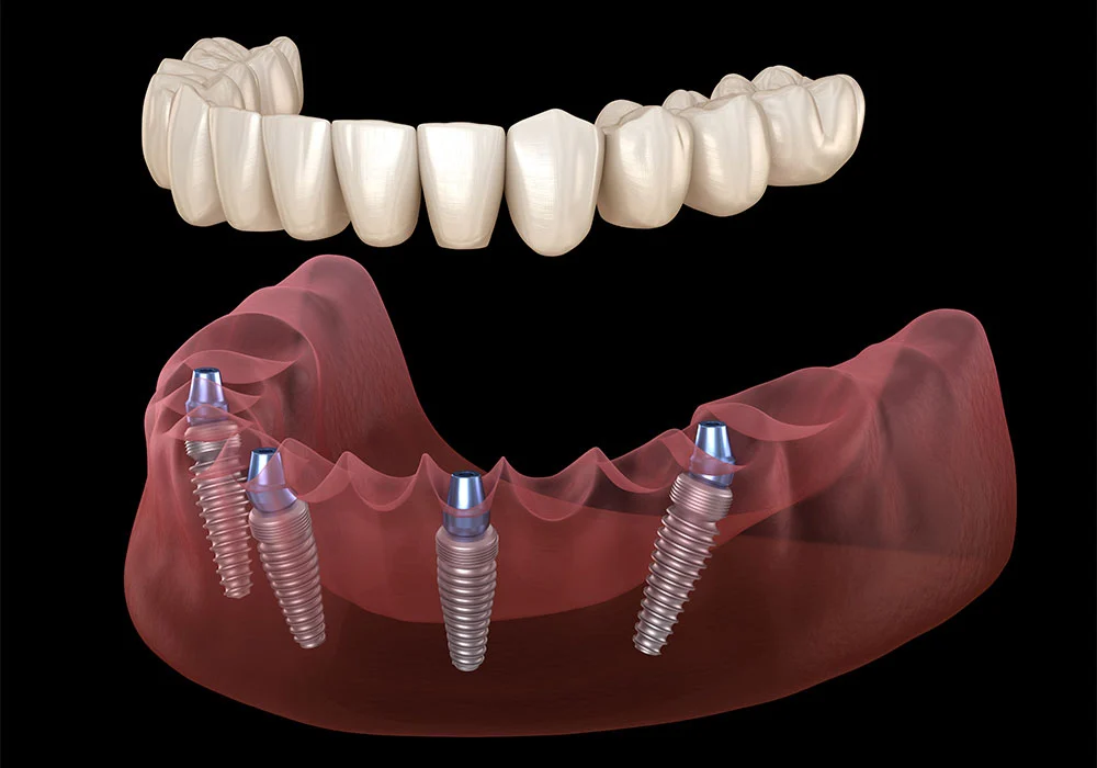 1 day dental implants