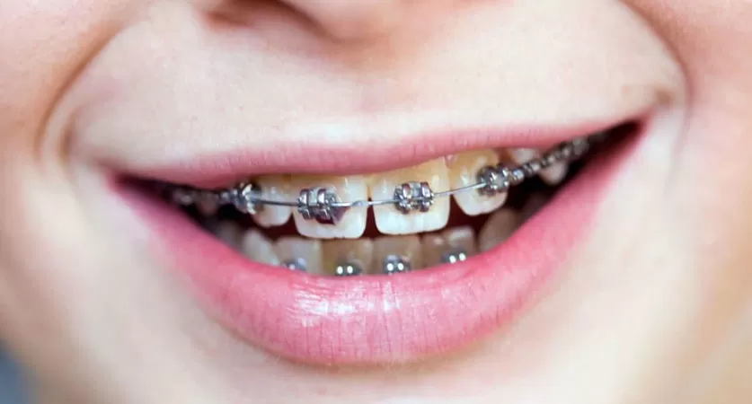 how long does it take to put on braces