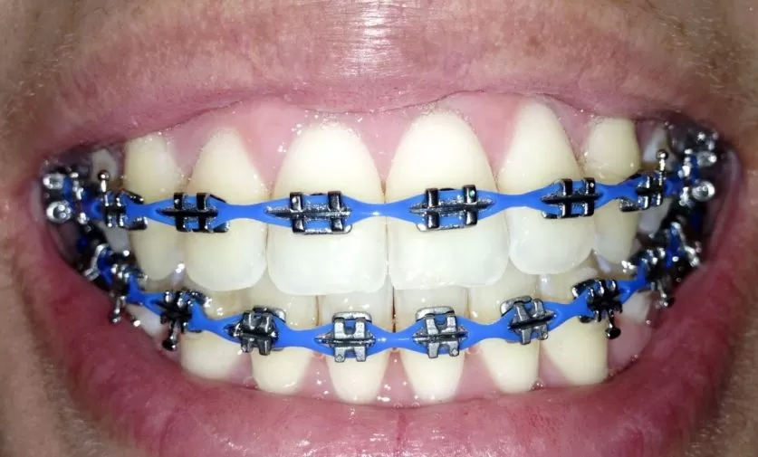 braces power chain