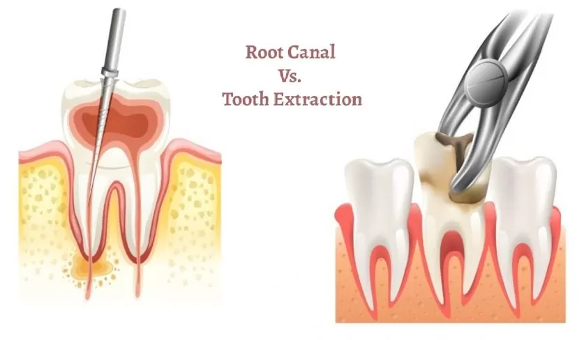Root Canal Vs. Extraction