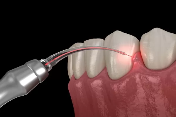 LANAP Laser Dentistry