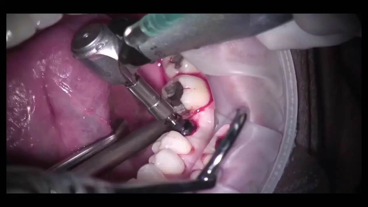Tooth Implant Surgery
