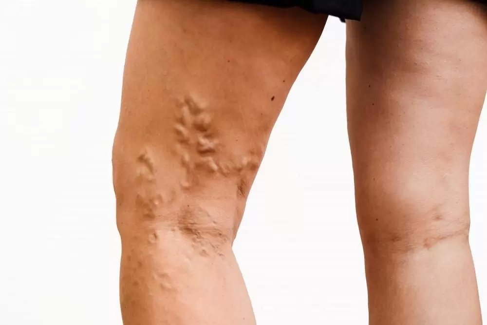 How Much Does Varicose Vein Treatment Cost