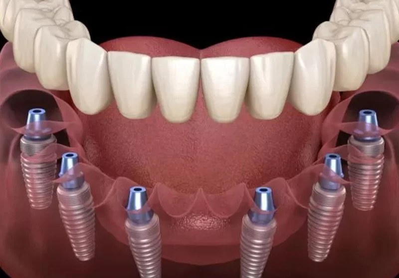 dental implant near me