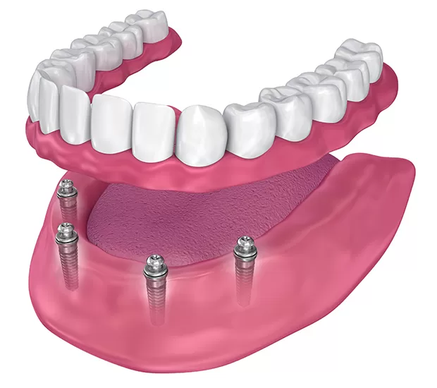 full mouth dental implants in Sunny Isles Beach